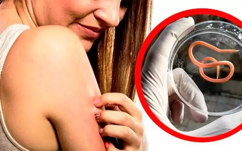 свербіж та подразнення при паразитах в організмі