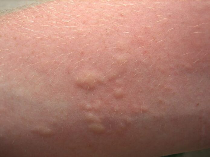 сверблячі алергічні висипання на шкірі можуть бути симптомами аскаридоза