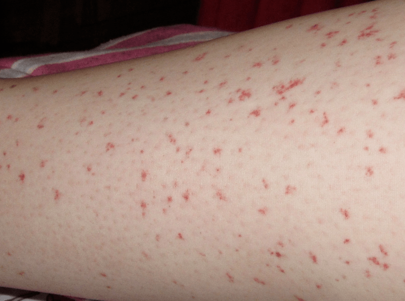 Висипання на шкірі – ознака гострої стадії зараження глистами